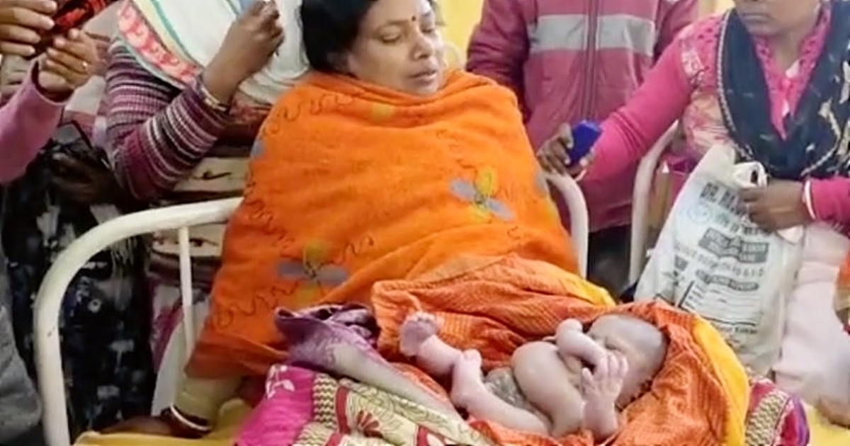 Un bébé né avec quatre bras et quatre jambes en Inde