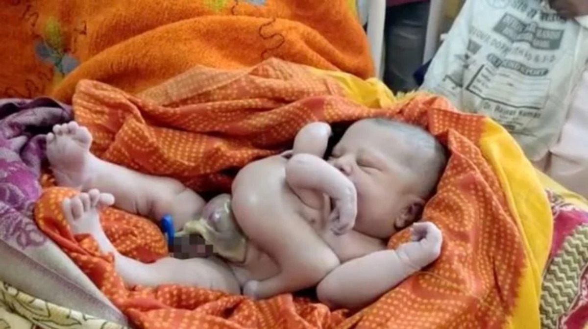 Un bébé né avec quatre bras et quatre jambes