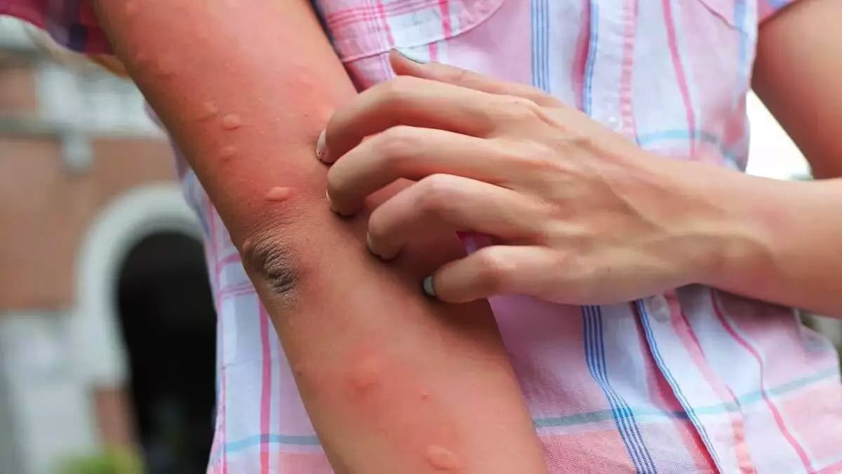 La piqûre la plus douloureuse de l'été